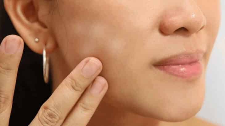 كيفية علاج البقع البيضاء في الوجه بسبب نقص الفيتامين