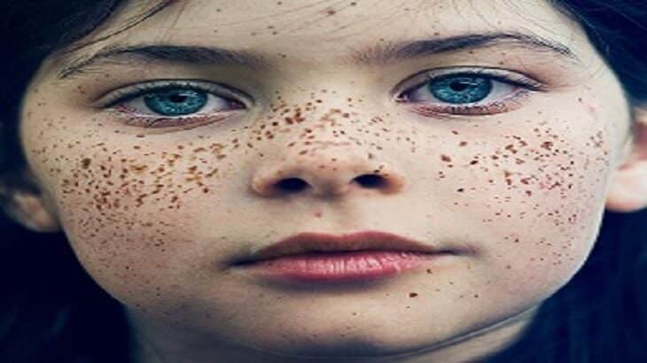 وصفات لإزالة النمش في الوجه باسرع وقت