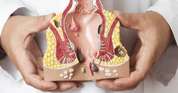 أعراض البواسير في بدايتها وأسبابها وكيفية علاجه