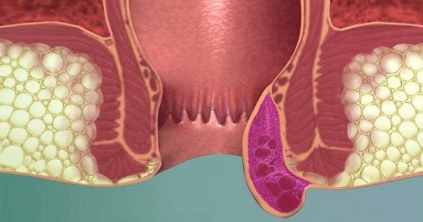 أعراض البواسير في بدايتها وأسبابها وكيفية علاجه