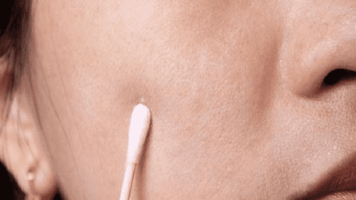 أفضل علاج طبيعي لحب الشباب واثاره