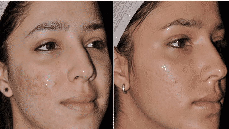 أفضل علاج طبيعي لحب الشباب واثاره