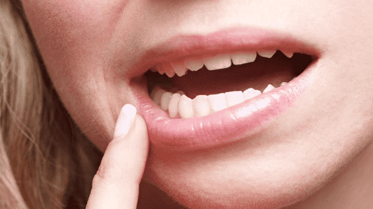 علاج التهاب اللثة الشديد ورائحة الفم الكريه