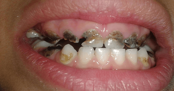 علاج تسوس الاسنان عند الاطفال في المنزل