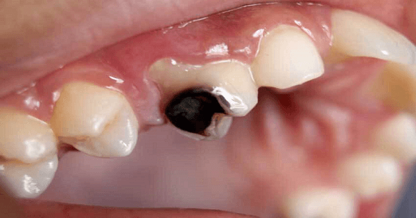 علاج تسوس الاسنان عند الاطفال في المنزل