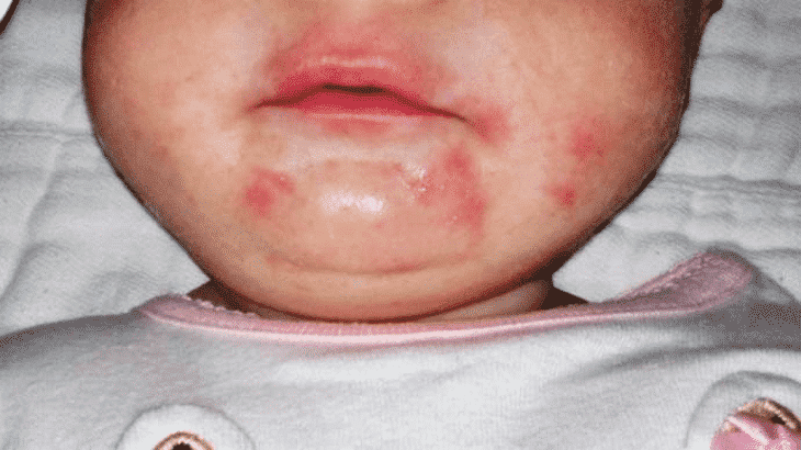 13 وصفة طبيعية لعلاج حساسية الوجه نهائيا