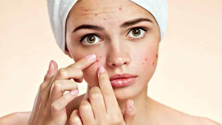 أفضل علاج طبيعي لحب الشباب واثاره