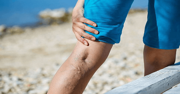 طرق مميزة لعلاج الدوالي بالأعشاب والزيت