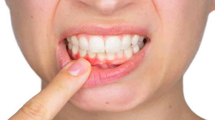 علاج التهاب اللثة الشديد ورائحة الفم الكريهة