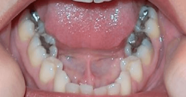علاج تسوس الاسنان عند الاطفال في المنزل