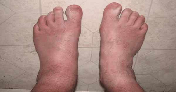 أعراض جلطة القدم بالتفصيل وعلاجها
