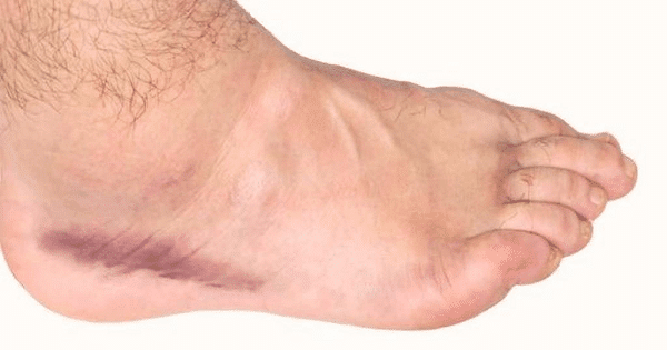 أعراض جلطة القدم بالتفصيل وعلاجها