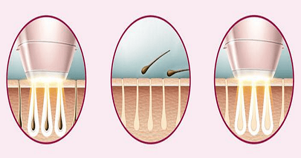 افضل طريقة لإزالة الشعر من المناطق الحساسة