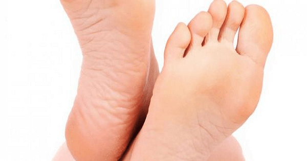 طريقة علاج تشققات القدمين وخشونتها بالاعشاب
