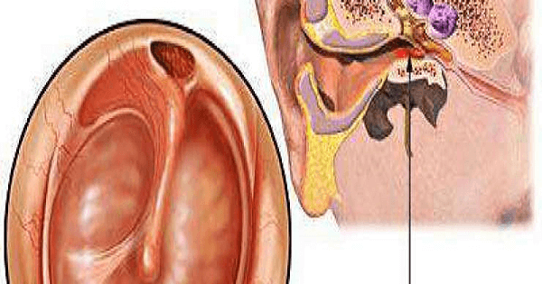 علاج التهاب الاذن الوسطى عند الكبار بالاعشاب الطبيعية