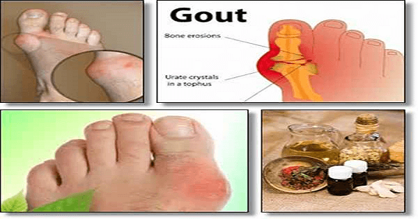 علاج النقرس والأملاح بالأعشاب الطبيعية