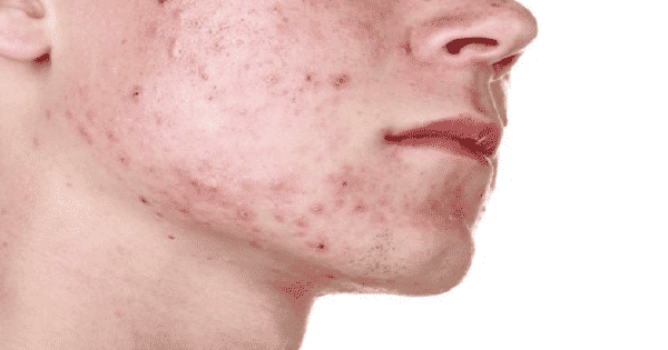 نصائح لعلاج بثور الوجه بسرعة