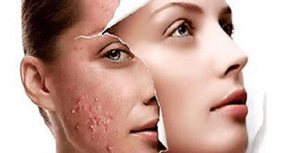 9 نصائح مميزة لترطيب البشرة الدهنية