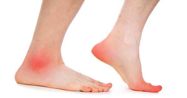 أعراض جلطة القدم بالتفصيل وعلاجها