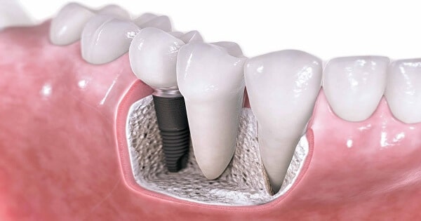أفضل مضاد حيوي طبيعي لالتهاب الأسنان