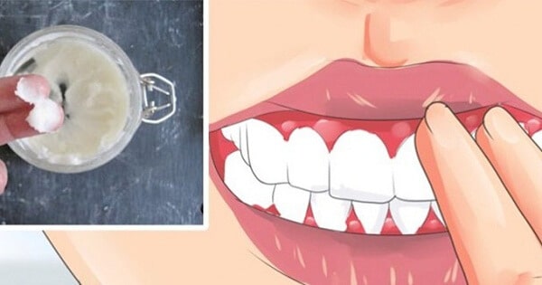 علاج التهاب اللثة وانتفاخها في المنزل بالاعشاب