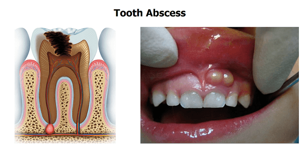 علاج خراج الأسنان بالمضاد الحيوي بالتفصيل
