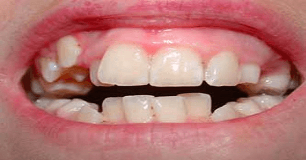 علاج خراج الأسنان بالمضاد الحيوي بالتفصيل