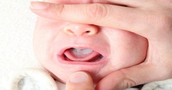 علاج فطريات اللسان عند حديثي الولادة