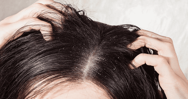 كيفية التخلص من قشرة الشعر نهائيا في أسرع وقت