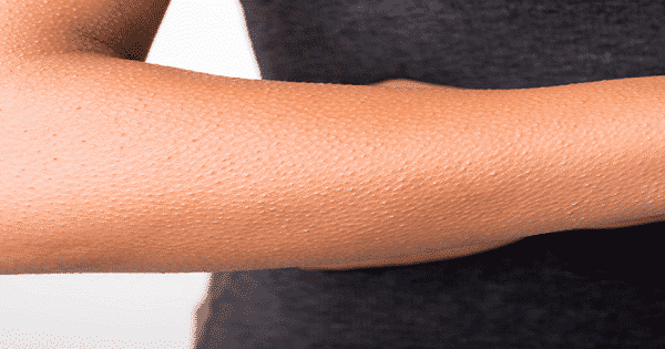 كيفية علاج نمو الشعر تحت الجلد
