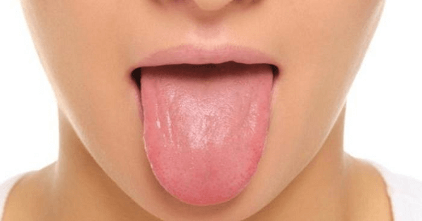 طرق علاج فطريات اللسان بالأعشاب الطبيعية