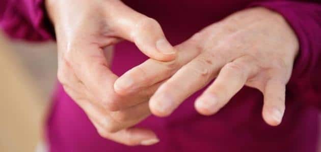 علاج الحمى الروماتيزمية بالأعشاب الطبيعية