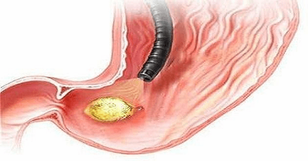 علاج قرحة المعدة والاثنى عشر بالاعشاب الطبيعية