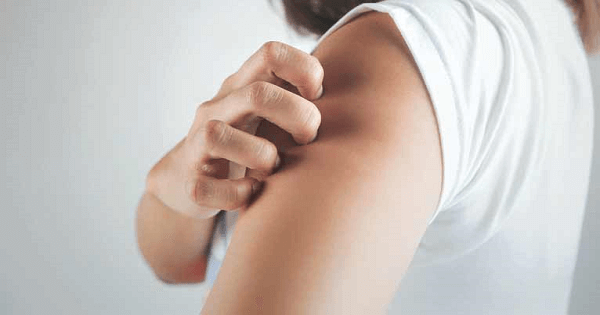 ماهو مرض الصدفية اسبابه وعلاجه