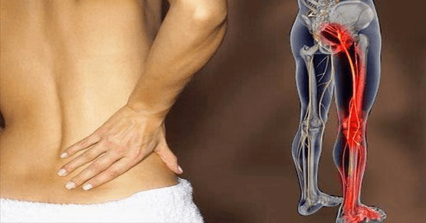تمارين مجربة للتخلص من عرق النسا نهائياً