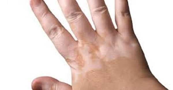 ماهو مرض الصدفية اسبابه وعلاجه