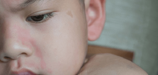 أساسيات انتفاخ الوجه المفاجئ عند الأطفال وطرق علاجه