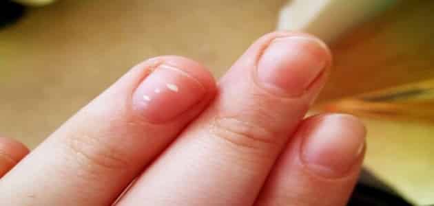 أسباب تكسر الأظافر الطولي عند الأطفال