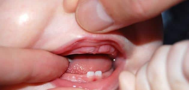 ترتيب ظهور الاسنان عند الاطفال