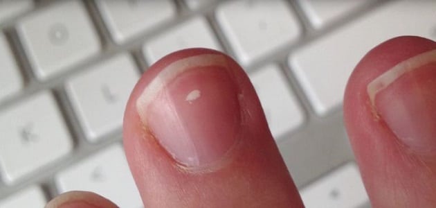 علاج النقط البيضاء في الأظافر عند الأطفال