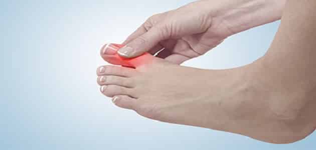 علاج زيادة حمض اليوريك بالأعشاب في الدم