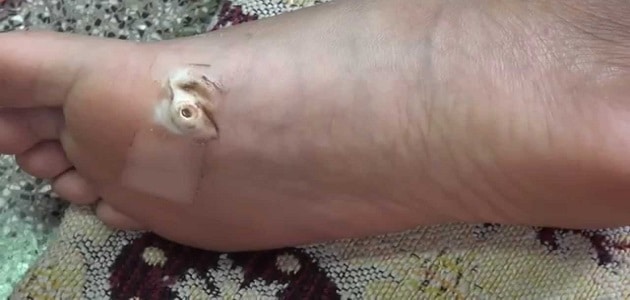 علاج عين السمكة في القدم بالثوم
