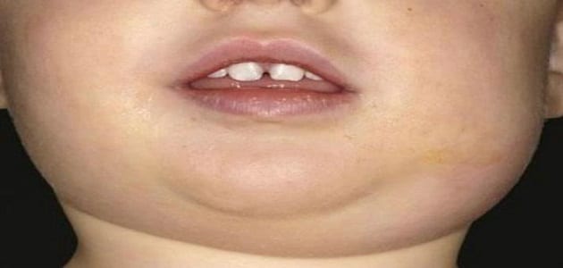 علاج مرض النكاف والعقم