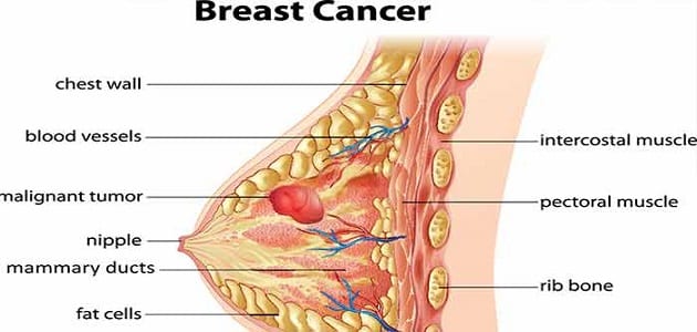 أعراض سرطان الثدي الحميد والخبيث بالتفصيل