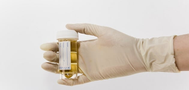 طرق علاج الصديد والاملاح بالأعشاب الطبيعية