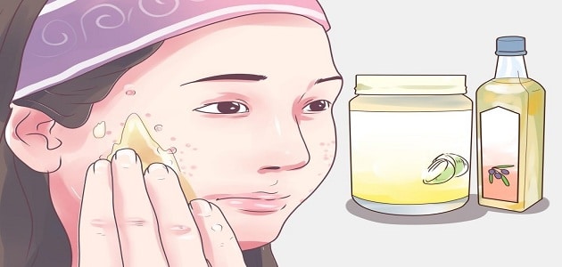 علاج حفر الوجه السطحية والعميقة بالليمون