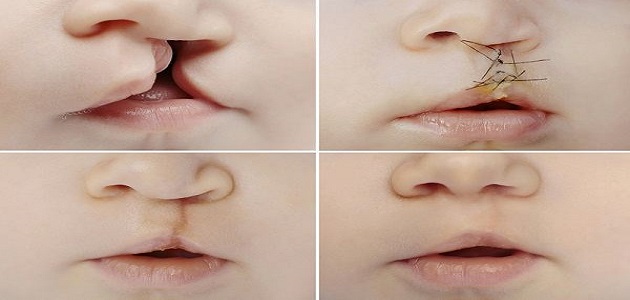أسباب الشفة الأرنبية وعلاجها بالليزر