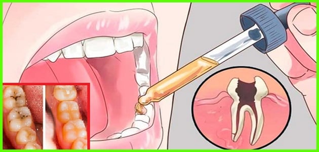 أضرار القرنفل على الأسنان