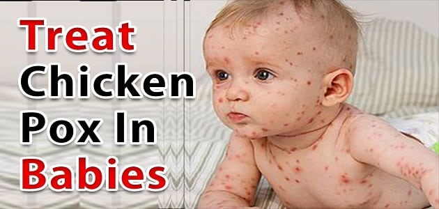 أعراض الجدري عند الأطفال وكيفية علاجه