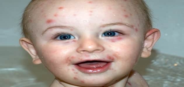 أعراض الجدري عند الأطفال وكيفية علاجه